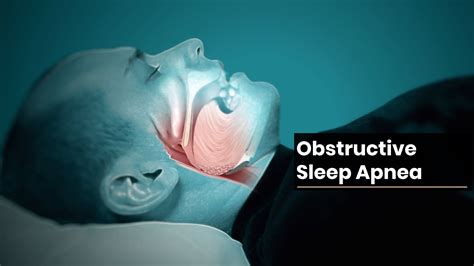 Image result for Obstructive Sleep Apnea