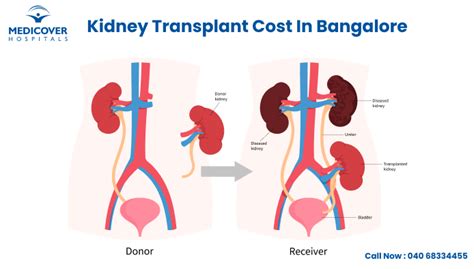 Kidney Transplant Cost in Bangalore - Medicover Hospitals