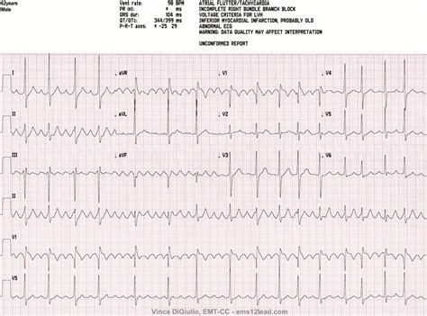 Atrial Flutter Ecg Introduction To Atrial Flutter On The ECG For New