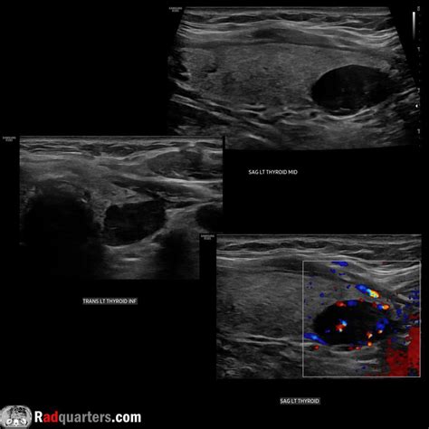 Adenoma De Paratireoide Giant Parathyroid Adenoma Associated With