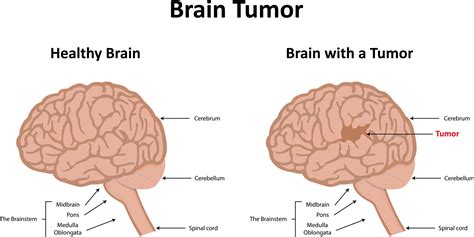 Brain Tumor Surgery Cost
