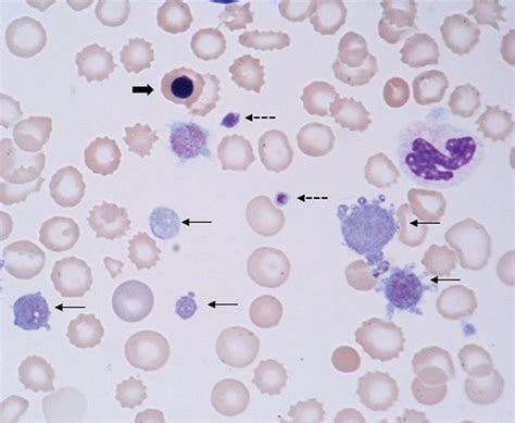 Nucleated Red Blood Cells Vs Lymphocyte