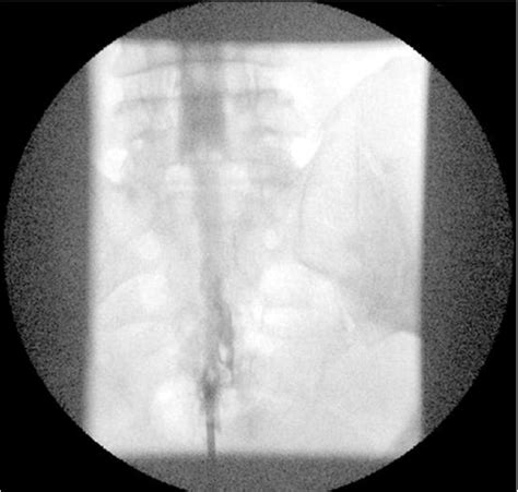 Image result for Myelogram Injection