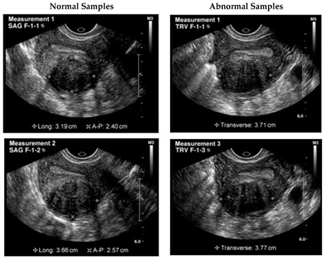 Automated Uterine Fibroids Detection in Ultrasound Images Using Deep ...