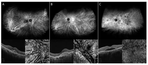 Diagnostics | Special Issue : Vitreo-Retinal Disorders: Pathophysiology ...