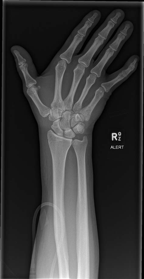 Fracture Of Triquetral Bone at Corinne Marx blog