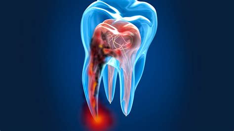 Diferentes teorías que explican porqué podemos tener caries en nuestros ...