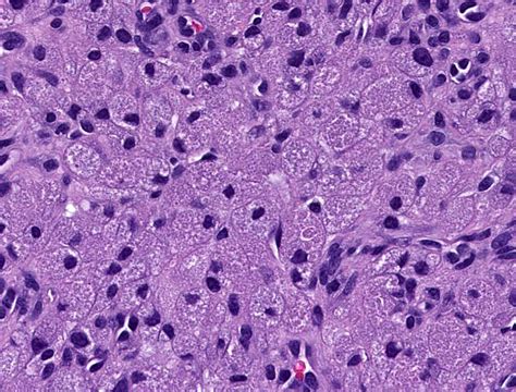Pathology Outlines - Granular cell tumor