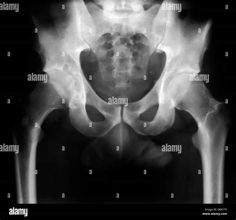 Normal Pelvis X Ray