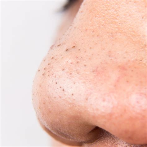 Blackheads On Nose