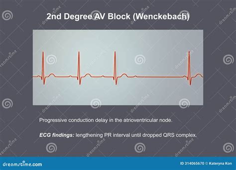 ECG of 2nd Degree AV Block Wenckebach , 3D Illustration Stock ...