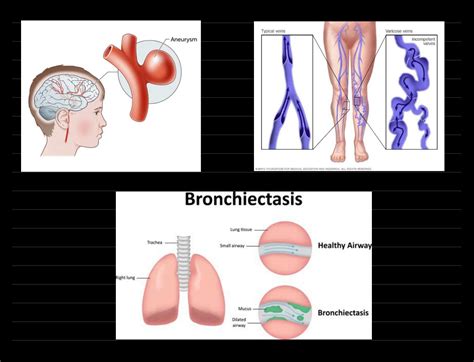SOLUTION: Urinary bladder diverticula acute chronic cystitis bilharziasis urothelial carcinoma ...