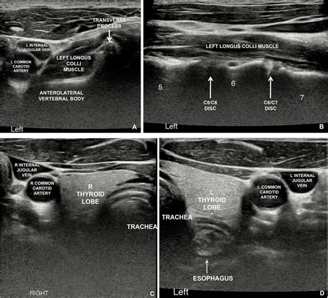 Visibility of Prevertebral Soft Tissues in the Neck Using Ultrasonography: A Feasibility Study ...