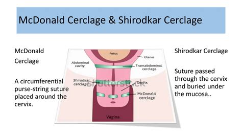 Cervical Cercalage Guidelines, it's types, indications and contraindications | PPTX