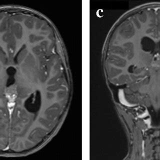 Image result for Intractable Diplopia