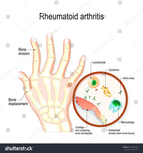 75 Types Knee Osteoarthritis Images, Stock Photos & Vectors | Shutterstock