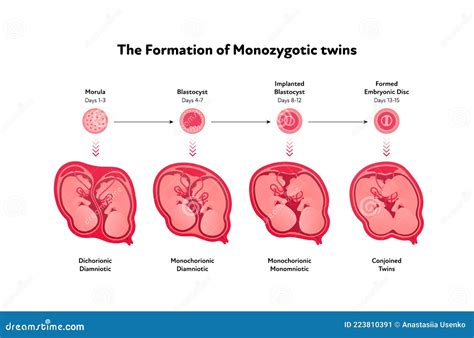 Dichorionic Diamniotic Twins With Fused Placenta Cartoon Vector ...