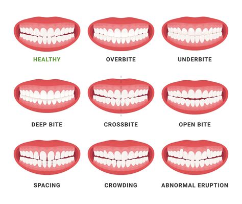 Ideal Bite Alignment Explained | PretoriaSmile Orthodontics