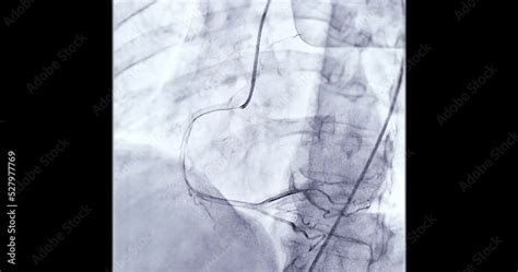 Coronary Angiogram Procedure 的图像结果