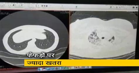 2021 में शक्तिशाली हुआ कोरोना, फेफड़ों को खतरा ज्यादा