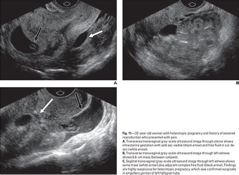 How Rare Is Ectopic Pregnancy