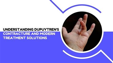 Understanding Dupuytren's Contracture and Modern Treatment Solutions ...