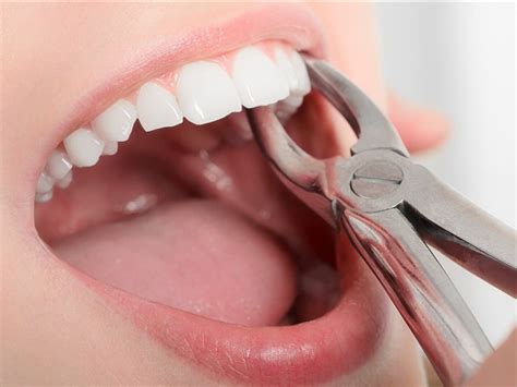 Image result for Tooth Extraction Surgery