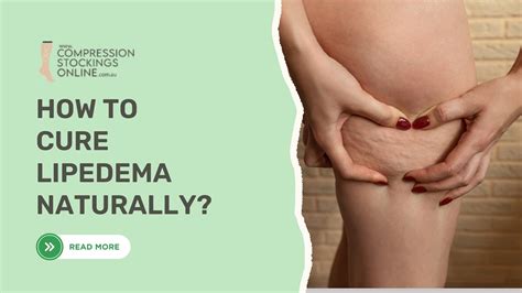 How to Cure Lipedema Naturally? Is Surgery the Only Option– Compression Stockings Online