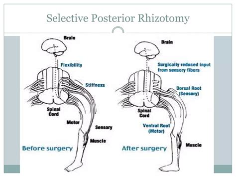Cerebral Palsy | PPTX