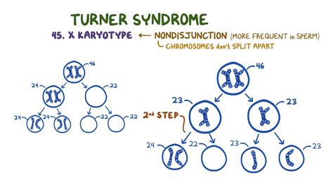 Turner Syndrome Variants at Carolyn Anderson blog