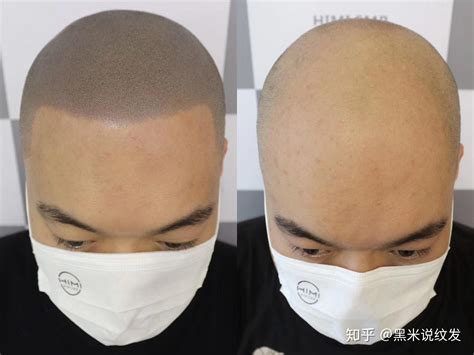 比植发更好？神奇的新技术，详解黑米3D纹发技术怎样解决秃顶的？ - 知乎