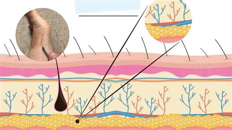 Image result for Hair Splinter Infection