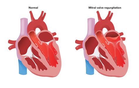 Fisiopatología De La Regurgitación Aórtica
