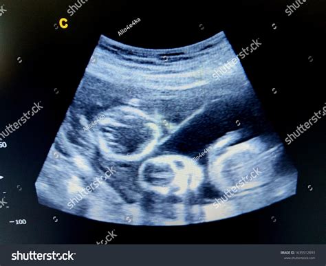 9 Week Ultrasound Identical Twins