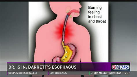 Barretts Esophagus Throat