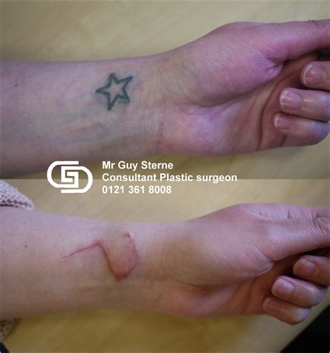 Tattoo Removal Before And After Scar