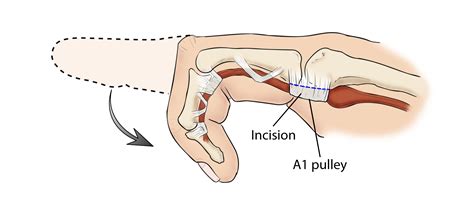 Trigger Finger - Trigger Thumb - OrthoInfo - AAOS