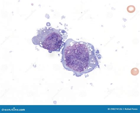 Pleural Lymphoma, Cytology. Stock Photo - Image of oncology, effusion: 298274126