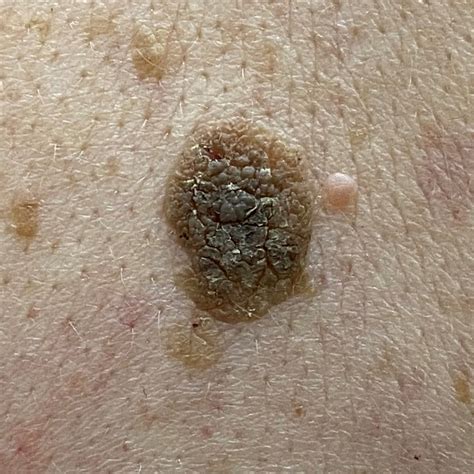 Seborrhoeic keratoses | Spot Check: skin cancer + aesthetics. Melbourne CBD