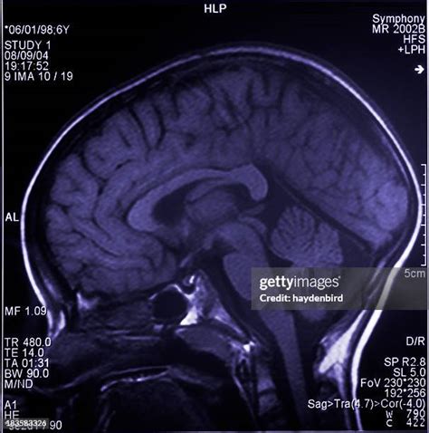 Image result for SPECT Scan Brain Prefrontal Cortex
