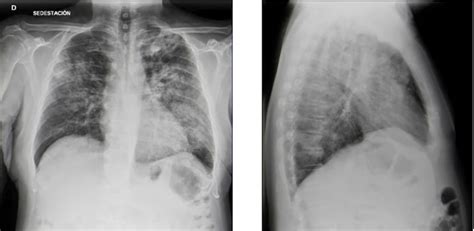 Síndrome de Goodpasture y enfermedad por anticuerpo antimembrana basal ...