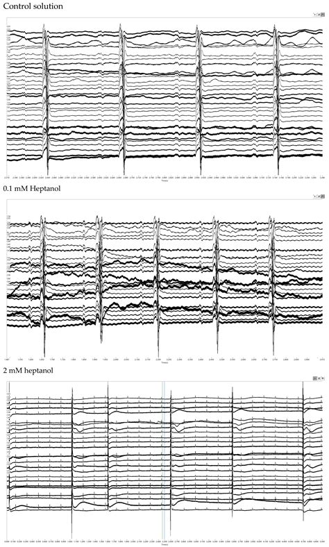 Heterogeneities in Ventricular Conduction Following Treatment with ...