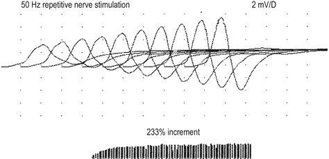 Image result for Repetitive Nerve Stimulation Test