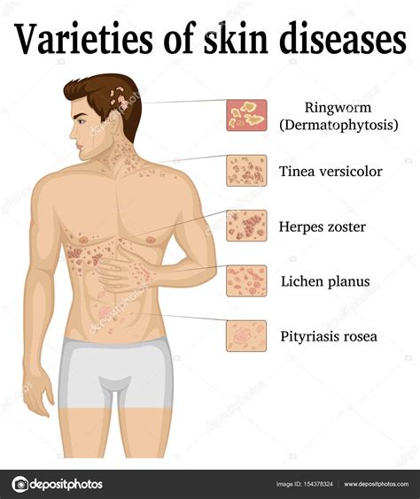 Pityriasis Rosea Linked To Cancer | ppgbbe.intranet.biologia.ufrj.br