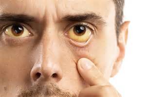 What are the early symptoms of hepatitis?