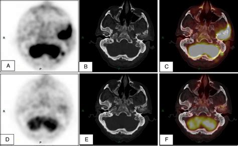 Necrotizing Otitis Externa
