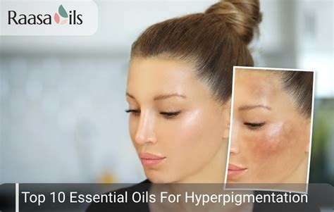 10 Best Essential Oils for Hyperpigmentation: Clear & Smooth Skin ...