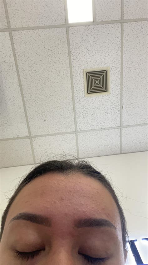 Small bumps on forehead, does anyone know what i can do to remove these? i’ve been using salylic ...