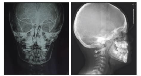 头颅头骨X光片中金属异物图片免费下载_红动中国