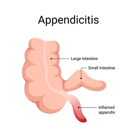 Diagram of appendix inflamed appendicitis disease | Premium Vector